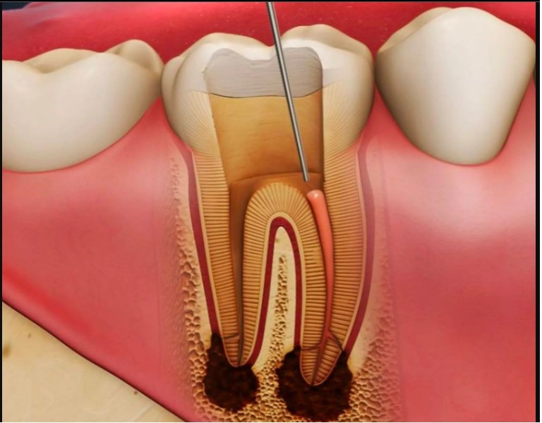 İltihaplı Diş Çekilir mi? Uzman Görüşleri ve Riskler